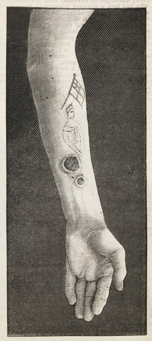 Syphilis infection in a tattoo. Illustration from Notes of Cases on an Outbreak of Syphilis following on Tattooing,in the British Medical Journal, May 4th, 1889. 